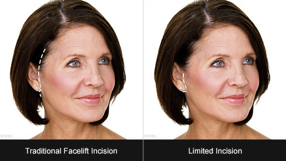 Facelift Incision Diagram