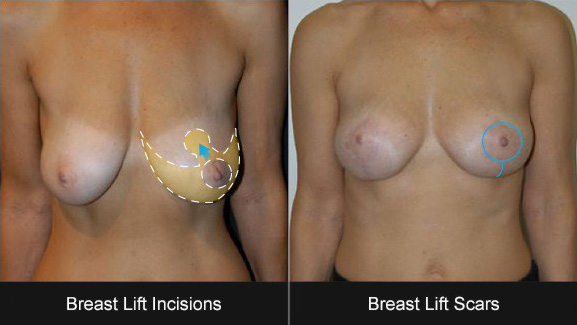 Breast Lift Incisions and Scars