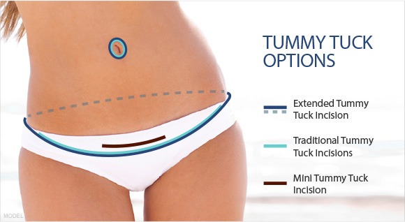 Tummy tuck incision diagram